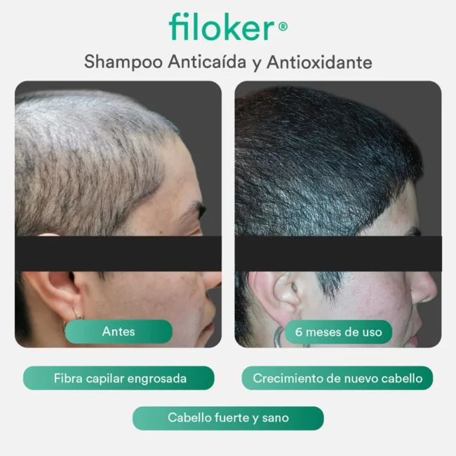 filoker_shampoo_antes-despues-02.webp filoker_shampoo_antes-despues-02.webp